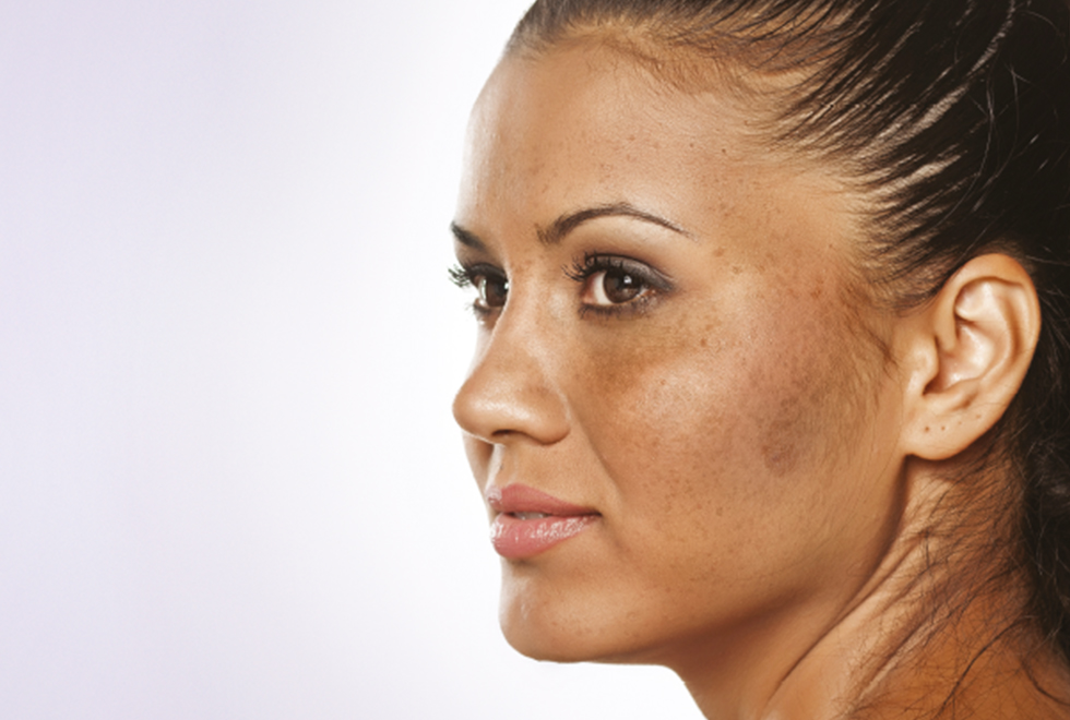 Melasma: 3 maiores erros que te impedem de controlar as manchas