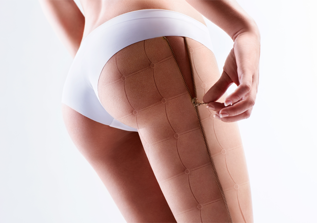 Qual o seu grau de celulite?