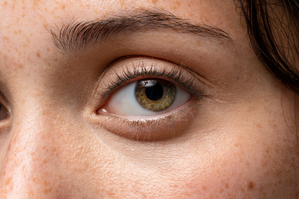 Quais os tipos e qual é o melhor tratamento para as olheiras?