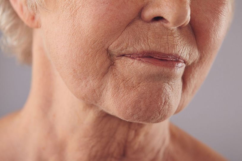 Tratamento facial para reduzir o bigode chinês e efeito lifting sem cirurgia