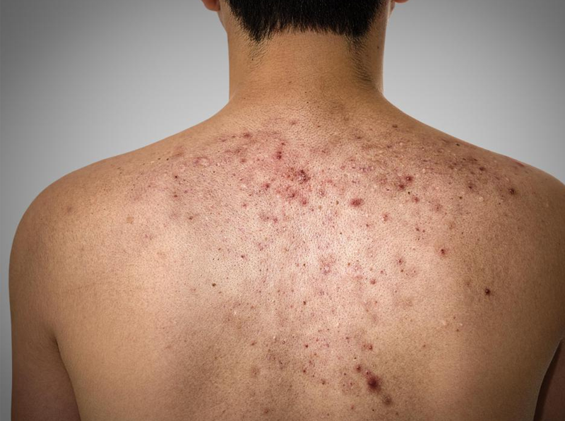 Espinhas nas costas?