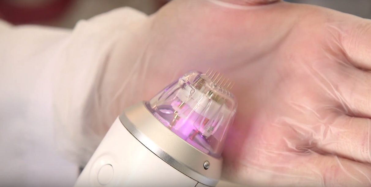 Tecnologia de ponta no combate as estrias: Microagulhamento Robótico