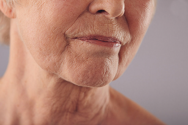 Sculptra trata a flacidez no rosto, pescoço e colo