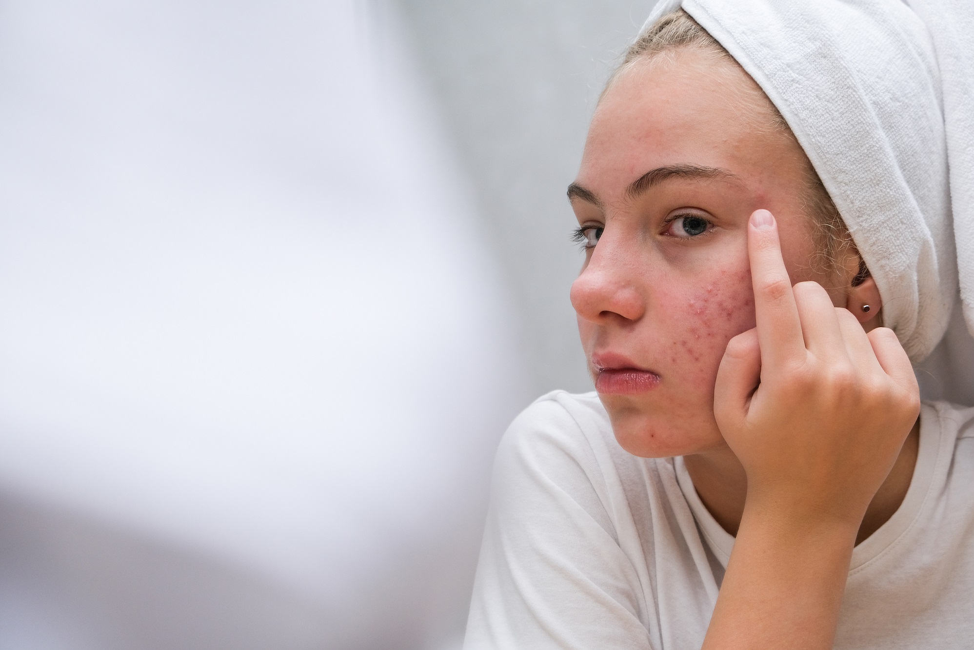 O guia simples e prático de como tratar cicatrizes de acne, manchas e cirurgias O guia simples e prático de como tratar cicatrizes de acne, manchas e cirurgias