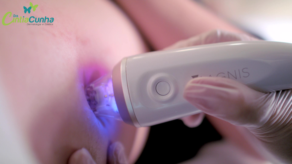 Microagulhamento robótico