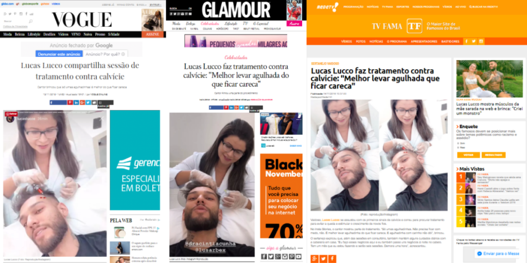 Lucas Lucco calvície